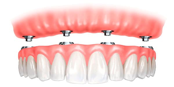 Prótese dentária total removível | Dra. Laíse Cunha