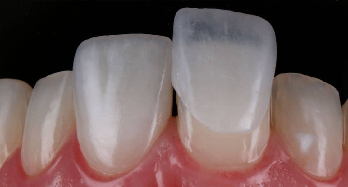 Sobre a Lente de Contato Dental | Dra. Laíse Cunha - Reabilitação Oral