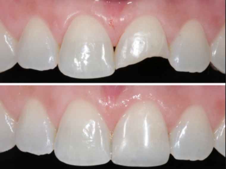 O que é a reabilitação oral estética restauracao-estetica em resina